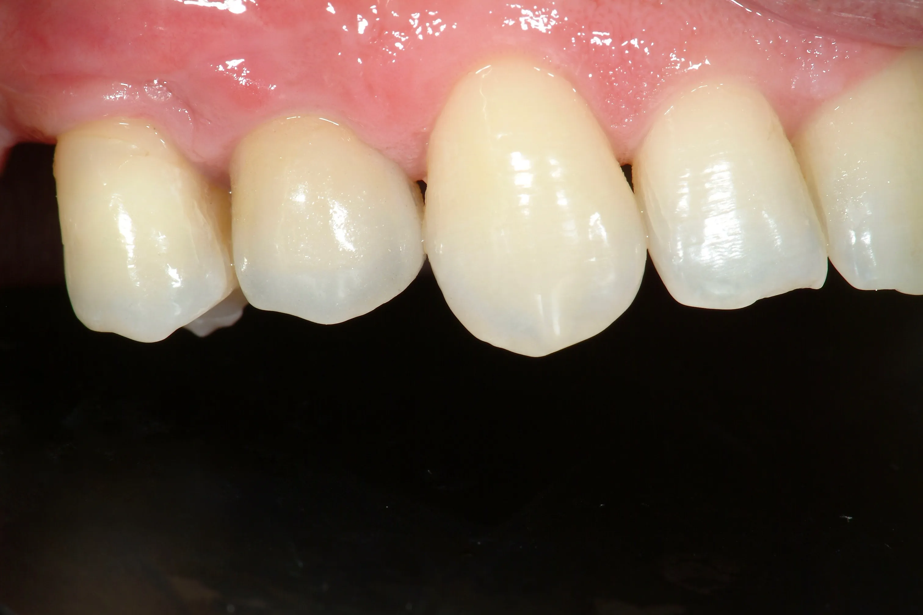 Riabilitazione implanto-protesica su dente fratturato